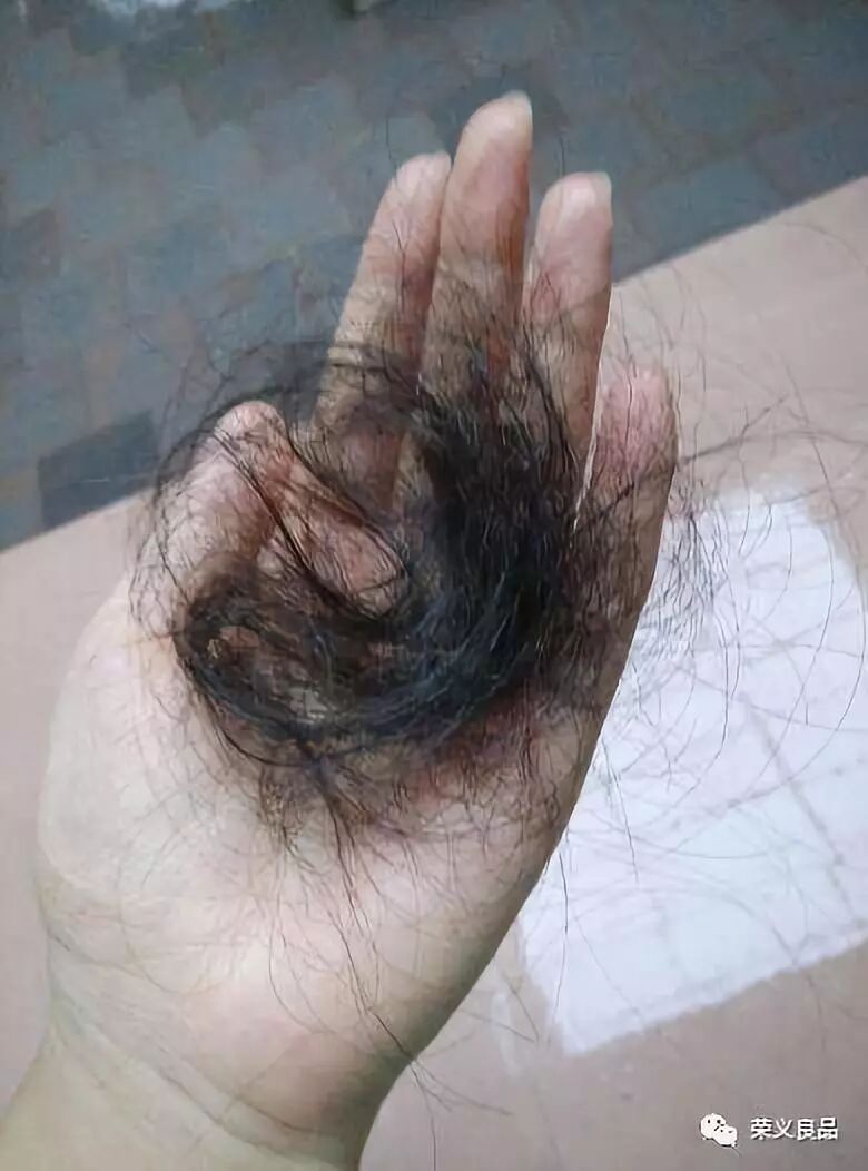 女性掉头发究竟有哪些原因所引起？（荣义良品圆您生发梦）