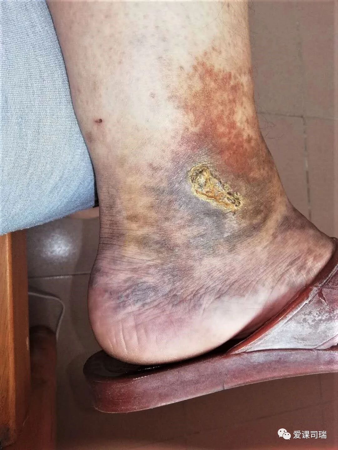 爱课敲板|为什么脚踝处会出现肿胀,变黑,溃烂?