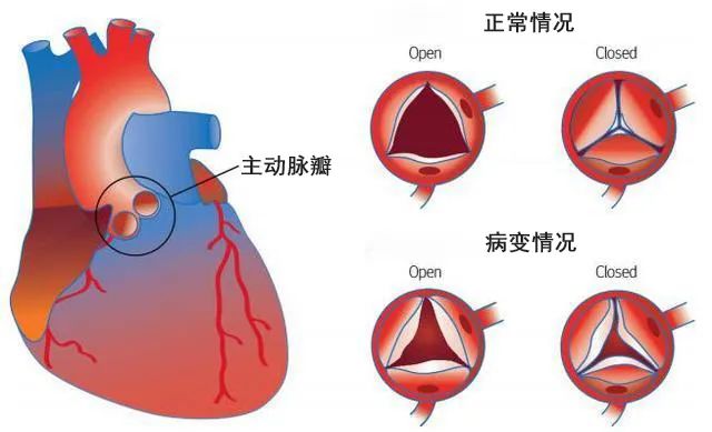 福建协和医院心外科戴小福主任 冬季心脏瓣膜病高发 Tavi手术带来新希望 快讯网