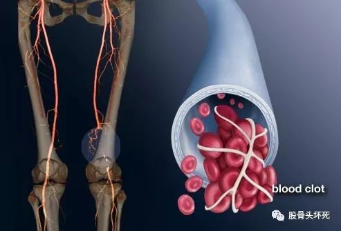 骨科大手术后下肢深静脉血栓形成 股骨头坏死 微信公众号文章阅读 Wemp