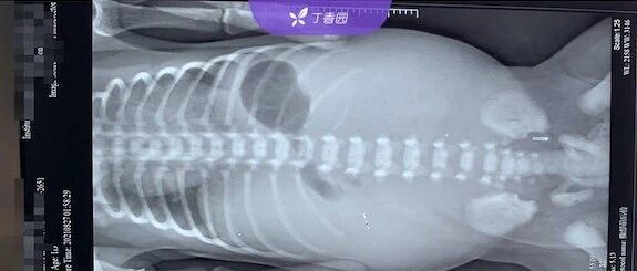 新生儿出生后肚子鼓得像「皮球」，感染性休克，原因竟是......