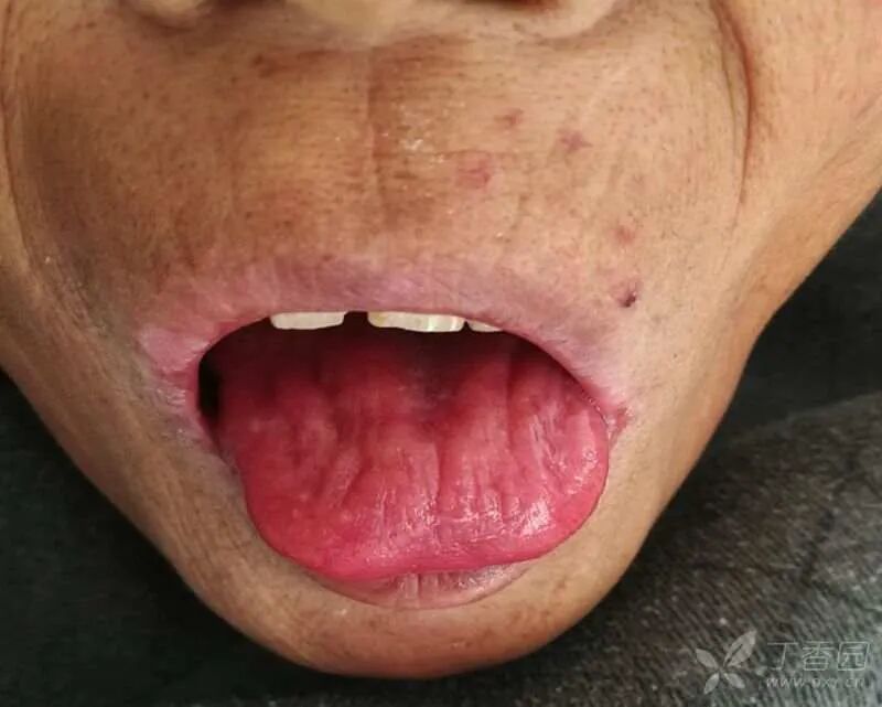 稍憋喘,面色晦暗,皮肤巩膜轻度黄染,全身散在瘀斑,舌体稍大,绛红,无苔