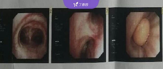 咳嗽 1 月余，时有痰中带血，最终竟诊断为「罕见病」？