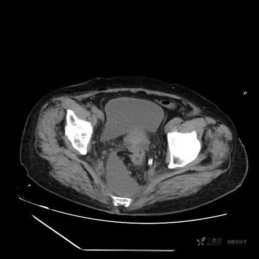 引流管怎么冲管教训！引流管流出墨绿色液体，冲管后患者却..._https://www.jmylbn.com_新闻资讯_第2张