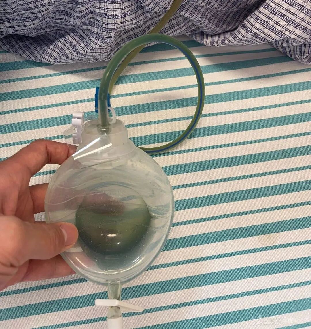 引流管怎么冲管教训！引流管流出墨绿色液体，冲管后患者却..._https://www.jmylbn.com_新闻资讯_第5张