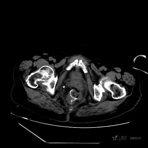 引流管怎么冲管教训！引流管流出墨绿色液体，冲管后患者却..._https://www.jmylbn.com_新闻资讯_第4张