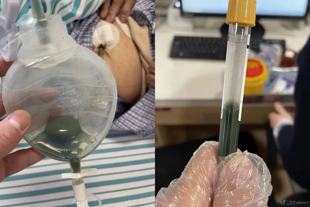 引流管怎么冲管教训！引流管流出墨绿色液体，冲管后患者却..._https://www.jmylbn.com_新闻资讯_第1张