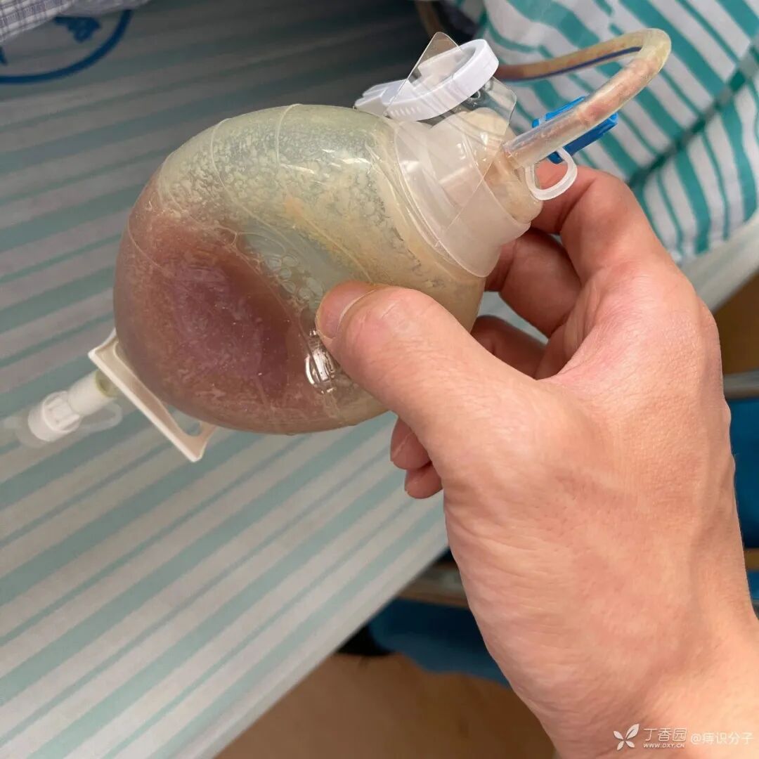 引流管怎么冲管教训！引流管流出墨绿色液体，冲管后患者却..._https://www.jmylbn.com_新闻资讯_第6张