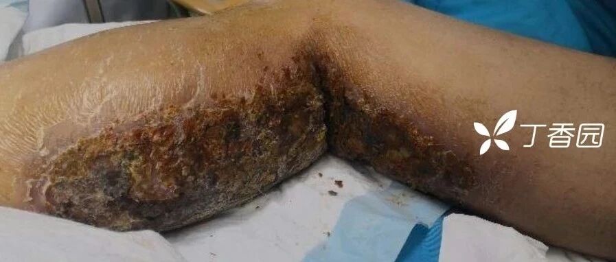 年轻小伙吃下 5 片安眠药，一觉醒来身上出现大片瘀斑！