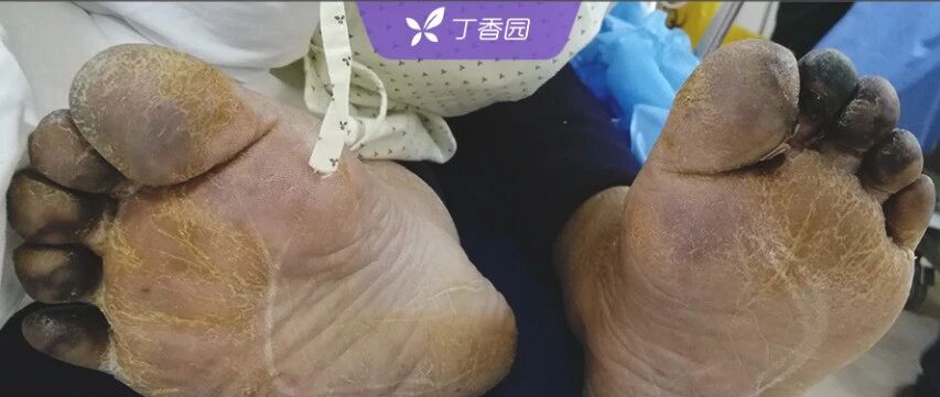 脚趾呈黑色，罕见的黑色胸水，病人死亡，考虑什么病？
