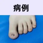 天生手脚指甲仅有「绿豆」大小，父母兄妹正常