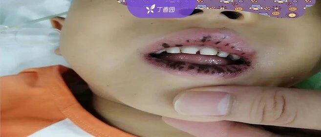 嘴唇上的点点黑斑 暗示一种遗传病