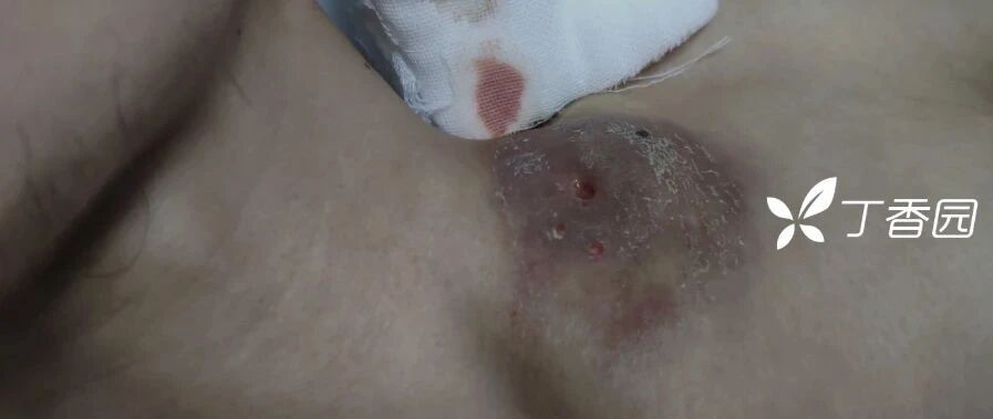 年轻小伙全身淋巴结破溃流脓，是谁在「啃食」他的身体？