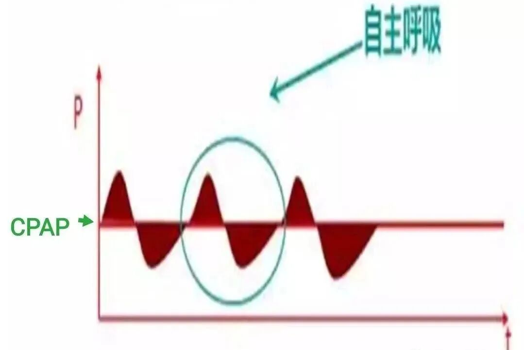 呼吸机湿化罐怎么加水【执业规范】无创呼吸机使用教程（收藏）_https://www.jmylbn.com_新闻资讯_第16张
