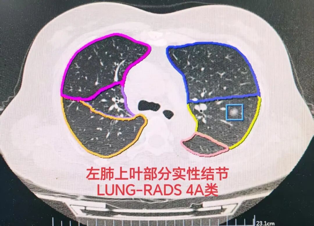 怎么制造手术钩针我院肺小结节“钩针”精准定位切除，让早期肺癌无处可藏！_https://www.jmylbn.com_新闻资讯_第2张