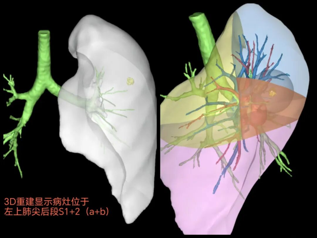 怎么制造手术钩针我院肺小结节“钩针”精准定位切除，让早期肺癌无处可藏！_https://www.jmylbn.com_新闻资讯_第3张