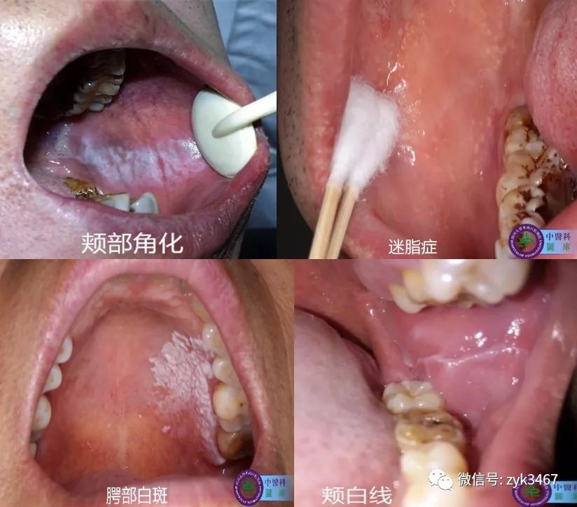 口腔扁平苔藓科普宣传资料 一 华西口腔中医科 微信公众号文章阅读 Wemp