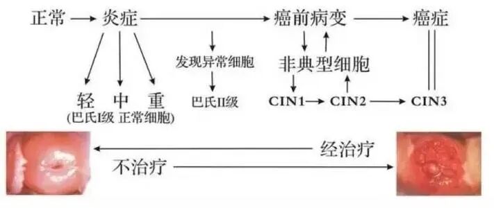 hpvdna分型分为什么型感染HPV病毒，为什么要做HPV分型定量检测？有什么意义？_https://www.jmylbn.com_新闻资讯_第8张