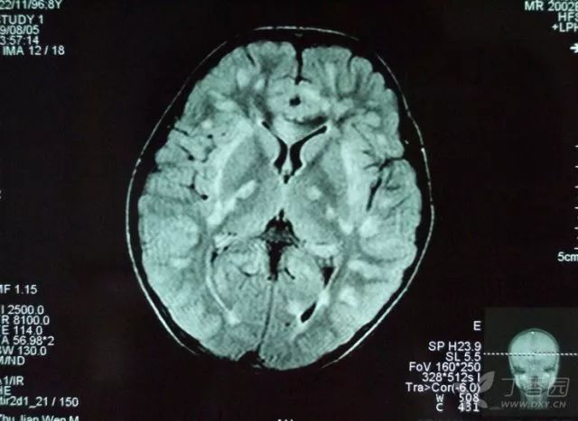 病毒性脑炎影像学表现