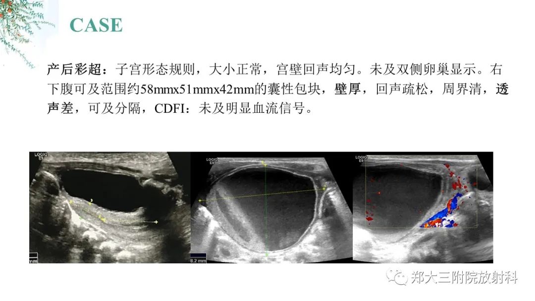 卵巢囊腫伴蒂扭轉影像診斷及鑑別