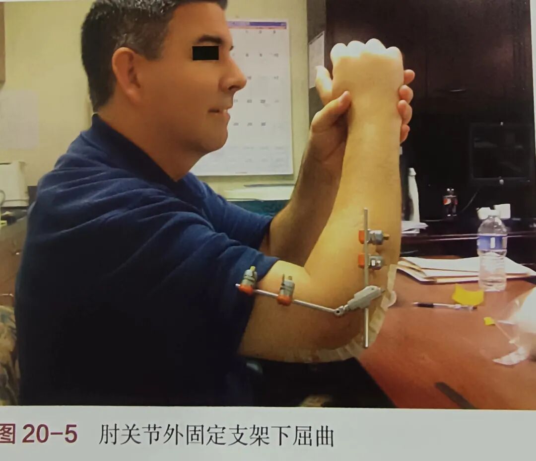 肘关节康复器怎么用肘关节骨折术后康复（一）_https://www.jmylbn.com_新闻资讯_第4张
