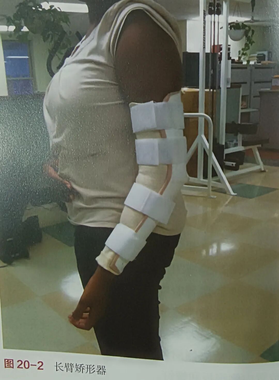 肘关节康复器怎么用肘关节骨折术后康复（一）_https://www.jmylbn.com_新闻资讯_第2张