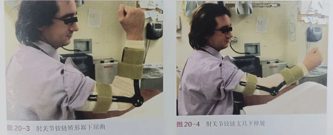 肘关节康复器怎么用肘关节骨折术后康复（一）_https://www.jmylbn.com_新闻资讯_第3张