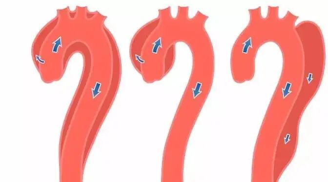 急性严重胸痛患者可能是主动脉夹层，一文了解如何诊治！