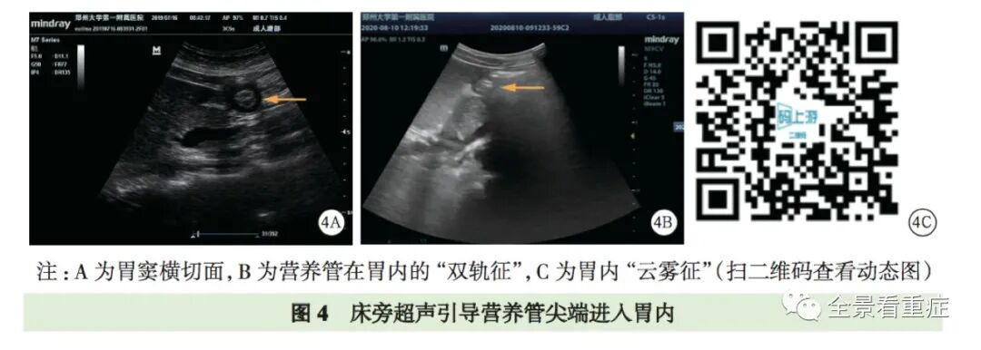 床旁x怎么使用基于循证的成人床旁超声护理专家共识（2020）_https://www.jmylbn.com_新闻资讯_第7张