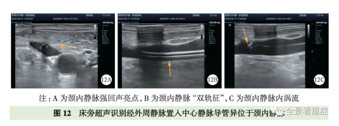 床旁x怎么使用基于循证的成人床旁超声护理专家共识（2020）_https://www.jmylbn.com_新闻资讯_第16张