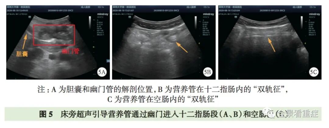 床旁x怎么使用基于循证的成人床旁超声护理专家共识（2020）_https://www.jmylbn.com_新闻资讯_第8张