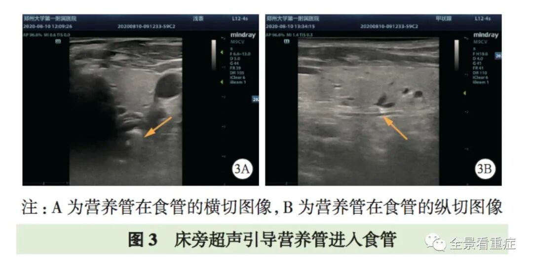 床旁x怎么使用基于循证的成人床旁超声护理专家共识（2020）_https://www.jmylbn.com_新闻资讯_第6张