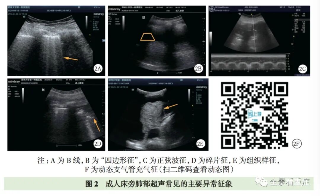 床旁x怎么使用基于循证的成人床旁超声护理专家共识（2020）_https://www.jmylbn.com_新闻资讯_第5张