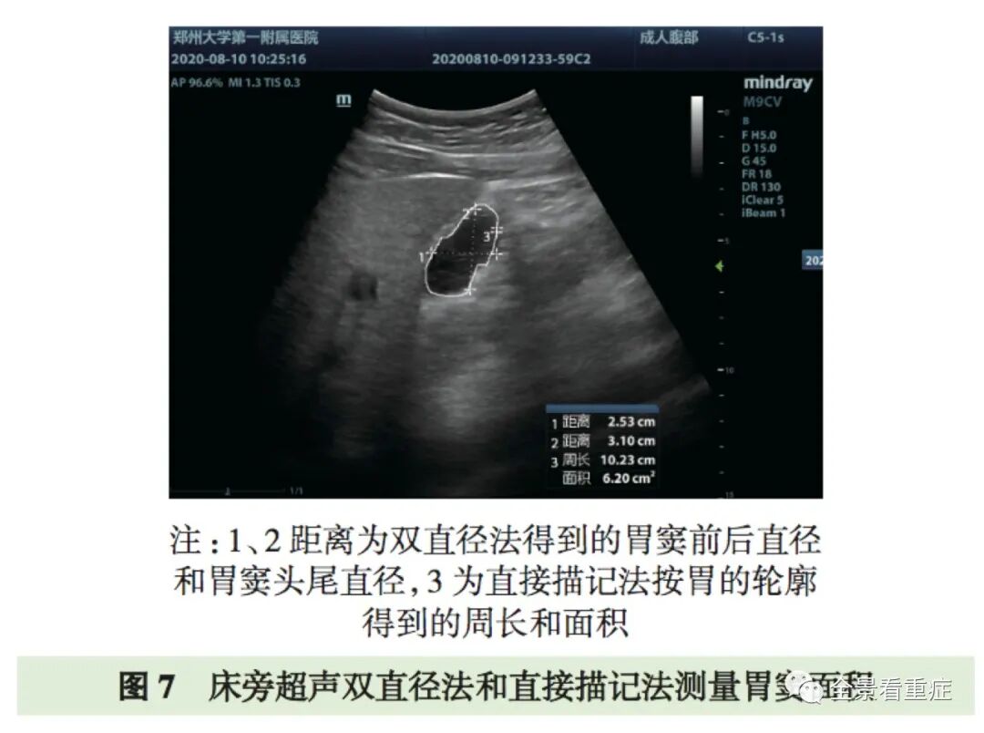 床旁x怎么使用基于循证的成人床旁超声护理专家共识（2020）_https://www.jmylbn.com_新闻资讯_第11张