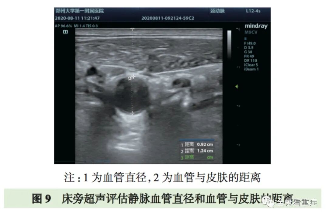 床旁x怎么使用基于循证的成人床旁超声护理专家共识（2020）_https://www.jmylbn.com_新闻资讯_第13张