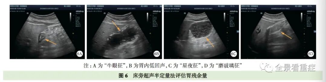 床旁x怎么使用基于循证的成人床旁超声护理专家共识（2020）_https://www.jmylbn.com_新闻资讯_第9张
