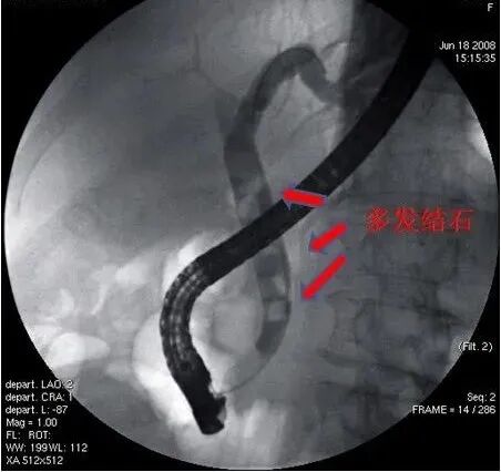取石网篮 为什么贵小小胆石危害大，内镜妙手助健康——内镜ERCP取石术，胆管结石患者的福音_https://www.jmylbn.com_新闻资讯_第2张