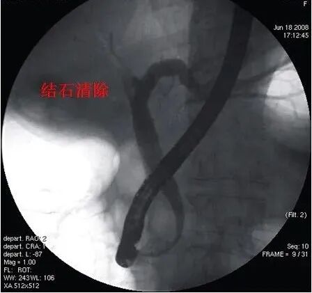 取石网篮 为什么贵小小胆石危害大，内镜妙手助健康——内镜ERCP取石术，胆管结石患者的福音_https://www.jmylbn.com_新闻资讯_第3张