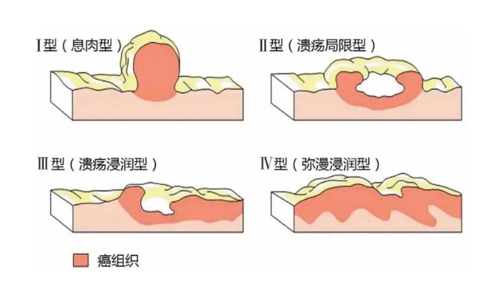 山田息肉分型图谱图片