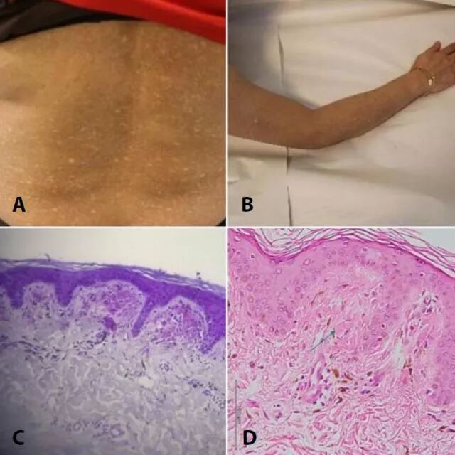 今日病例 色素异常性皮肤淀粉样变 皮肤时间 微信公众号文章阅读 Wemp