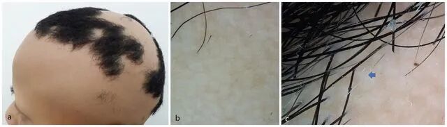 毛发旗帜征：斑秃的皮肤镜征象