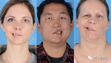美一名医护人员接种疫苗后，出现严重