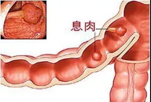 【警惕】胃腸息肉切除後一定要記得及時復查！防止胃腸癌的發生！！！ 汽車 第5張