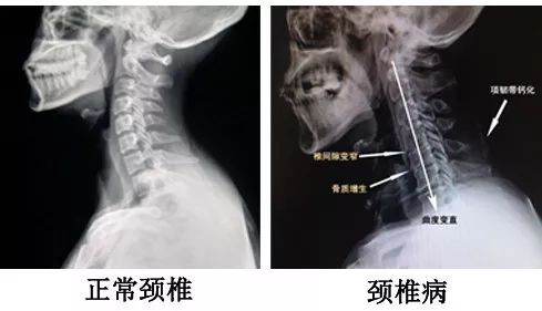 頸椎病的中醫辨證分型論治