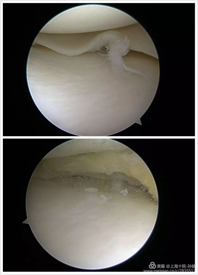板撕裂,予半月板成型術(下圖)探查見前交叉韌帶股骨支點撕裂,脛骨支點