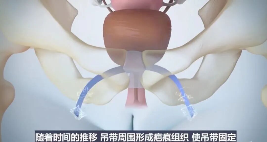 尿道张力过强怎么办西安市第五医院（陕西省中西医结合医院）妇产科开展经阴道闭孔无张力尿道中段悬吊术_https://www.jmylbn.com_新闻资讯_第4张