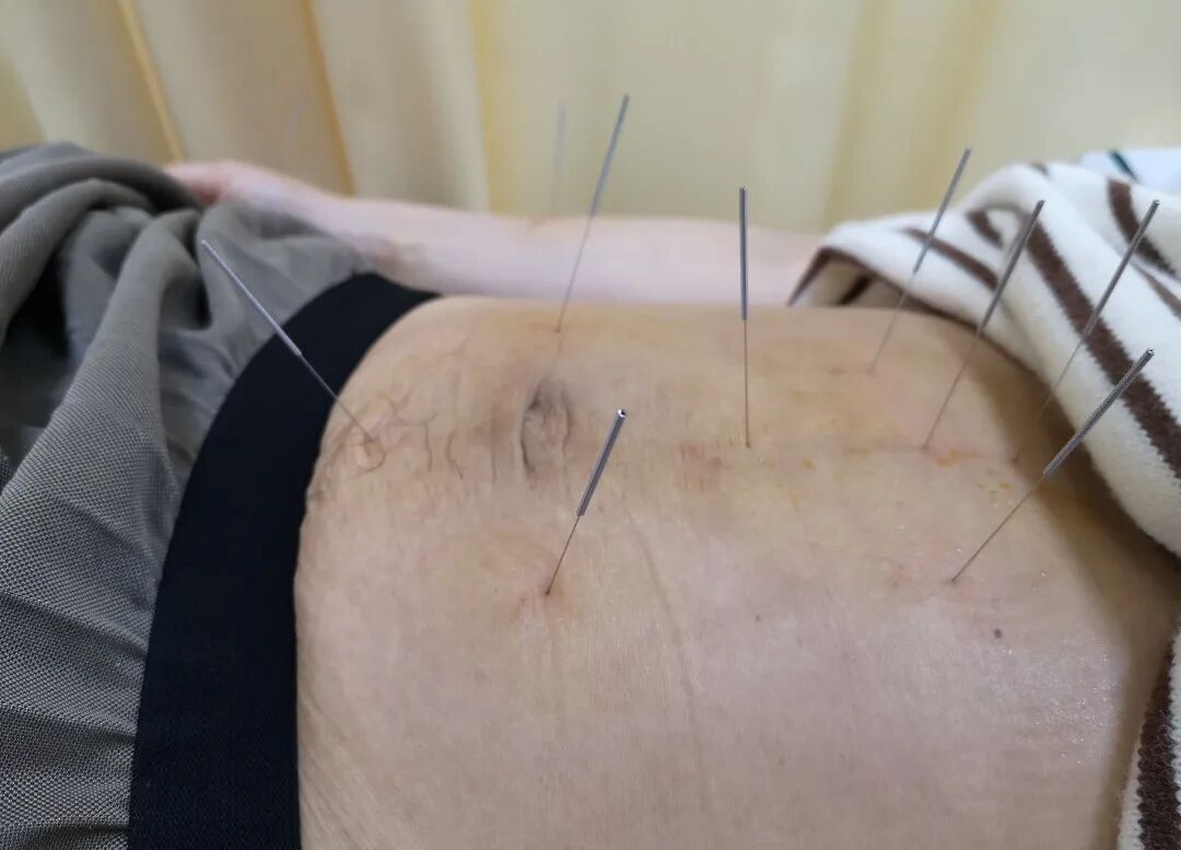 辨证施治丨从化区中医医院针灸康复科采用针灸手法治疗胃痛患者