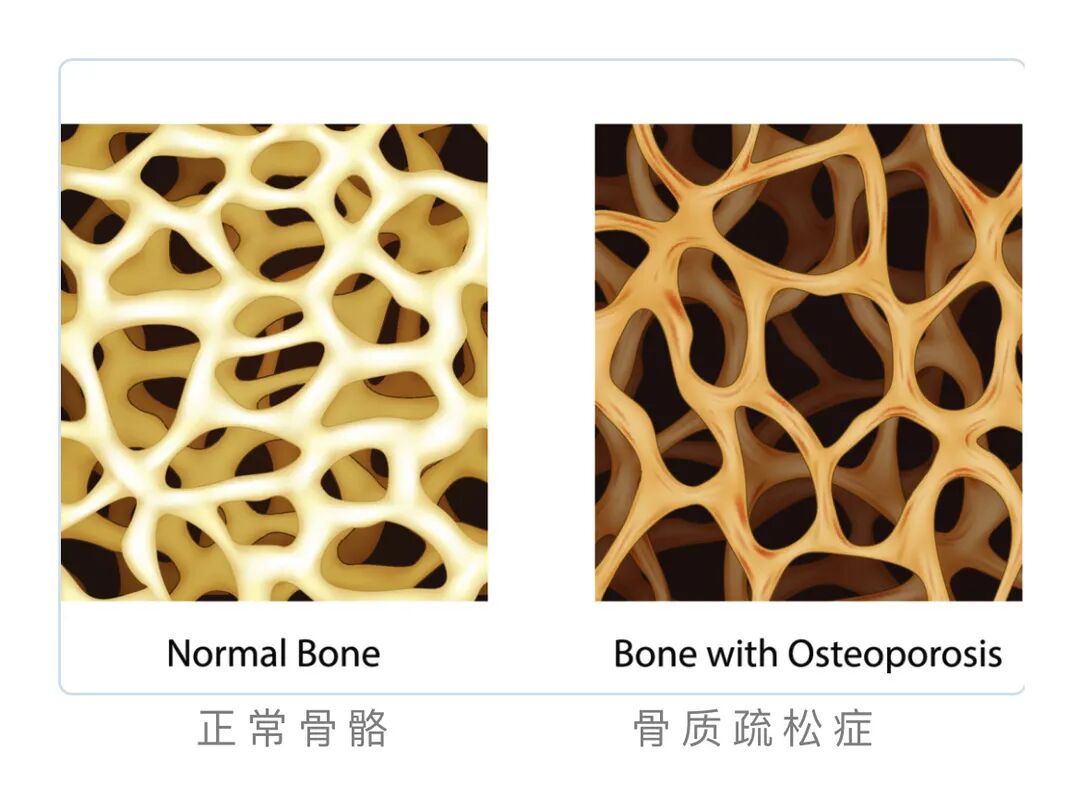 双能x骨密度检测仪为什么非得输入体重身高小心！千金难买老来瘦可能是病！——不信，来工人医院骨密度室做个体质分析检测吧_https://www.jmylbn.com_新闻资讯_第14张