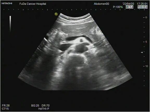 胰腺癌的超声诊断及IRE介入超声