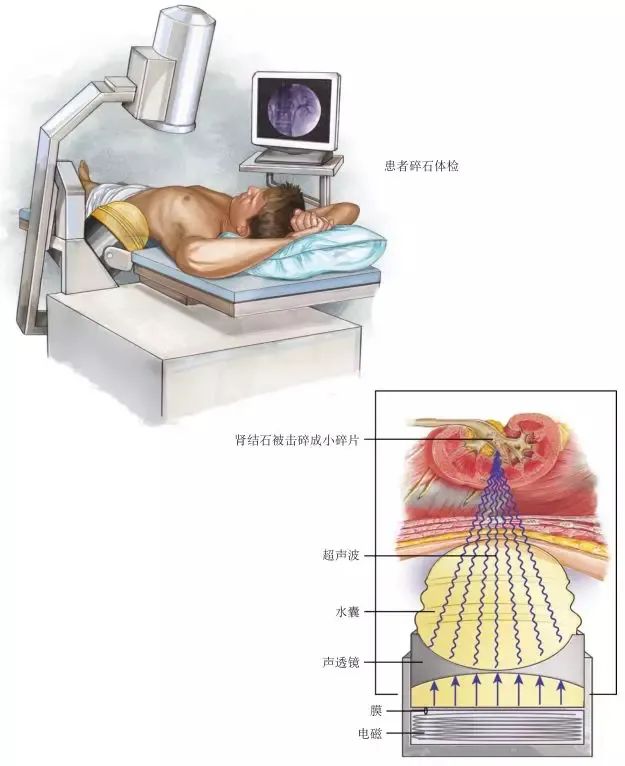 一文看懂体外冲击波碎石术的方方面面（图文详解）